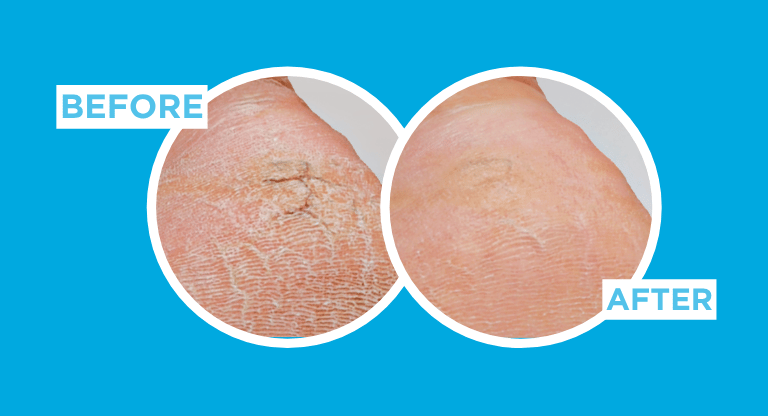 Two circular close-up heel images on a blue background labeled “BEFORE” and “AFTER.” The left image shows dry, cracked heel skin, while the right image shows a smoother-looking heel in a before-and-after comparison.