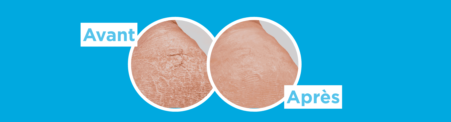 Bannière pour ordinateur présentant deux images circulaires en gros plan d’un talon sur fond bleu avec les mentions « Avant » et « Après ». L’image compare un talon présentant une peau sèche et craquelée à un talon à l’apparence plus lisse.