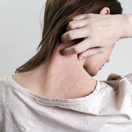 Eczema,What causes eczema,What causes dermatitis,Dermatitis,Dermatitis eczema difference
