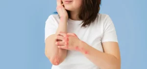 A woman on a blue background scratching her arm - wondering whats the difference between psoriasis vs eczema
