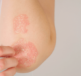 A close-up of a person's arm displaying a patch of psoriasis and fingers just about to scratch it.