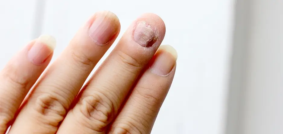 A hand with the nail on the middle finger infected with nail fungus