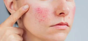 what could be causing your facial eczema and irritated skin