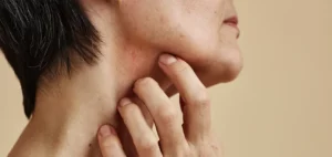 what is dermatillomania