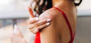 A woman in a red tank top applying Flexitol Dry Skin products to her severe dry skin - Xerosis
