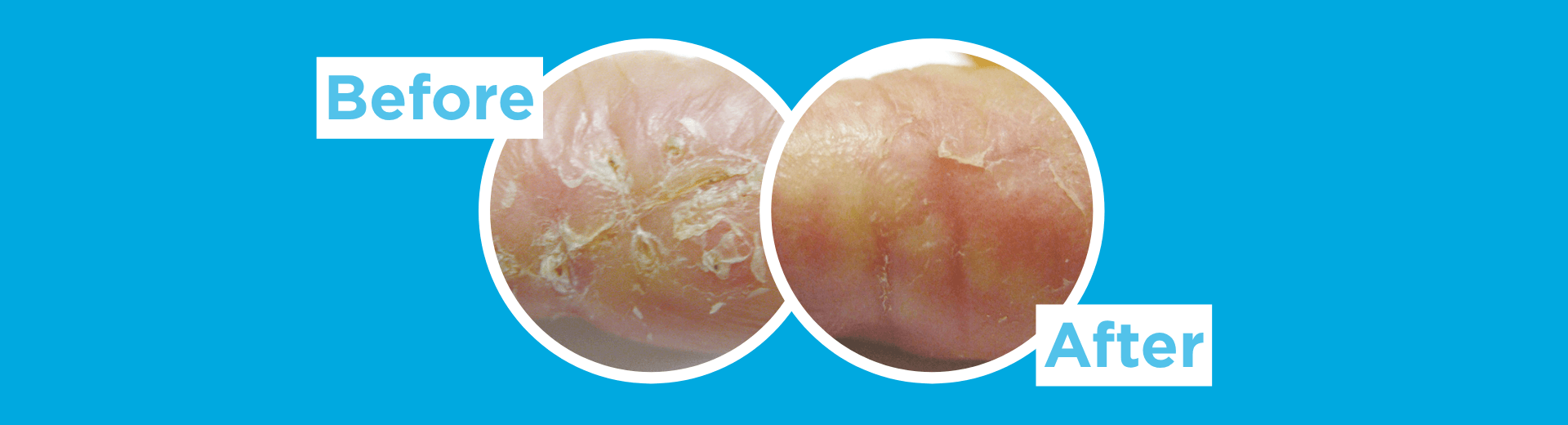 Side-by-side close-up comparison of dry, flaky skin labeled Before and After on a blue background