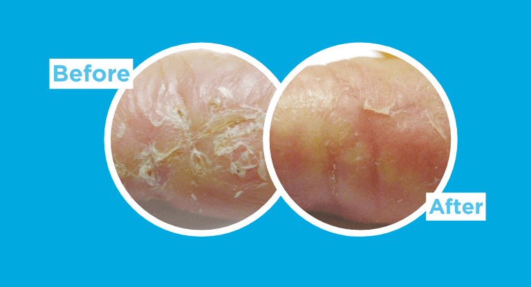 Side-by-side close-up comparison of dry, flaky skin labeled Before and After in a mobile banner format