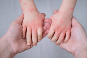 understanding eczema in babies and children tips for parents