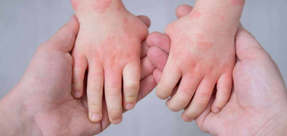 understanding eczema in babies and children tips for parents